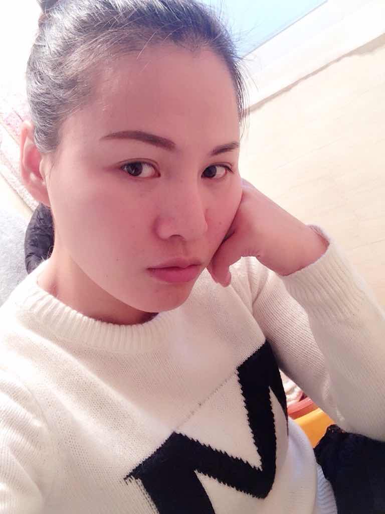 这是之前去泰国旅游的时候和老公拍的照片 化了妆贴了双眼皮贴双眼皮仍然被肿眼泡挡的看不见双眼皮 这是贴了非常宽的双眼皮贴,看上去总算是明显的撑出了双眼皮 但是眼皮还是感觉肿肿的 今天是做完双眼皮第11天 因为术后一直都没能好好的洗脸导致皮肤有点小过敏,所以今天好好敷个面膜来挽救一下 形状看上去还不错 还没完全消肿的状态 (因为楼主忍不住好几次偷吃辣消肿变慢了)医生说差不多要一个月的时间才能恢复完整 三个月到半年才会自然好看 好好闭关等完全恢复化个美美的妆再来对比一下 哈哈 第一次发帖之前一直在潜水状态