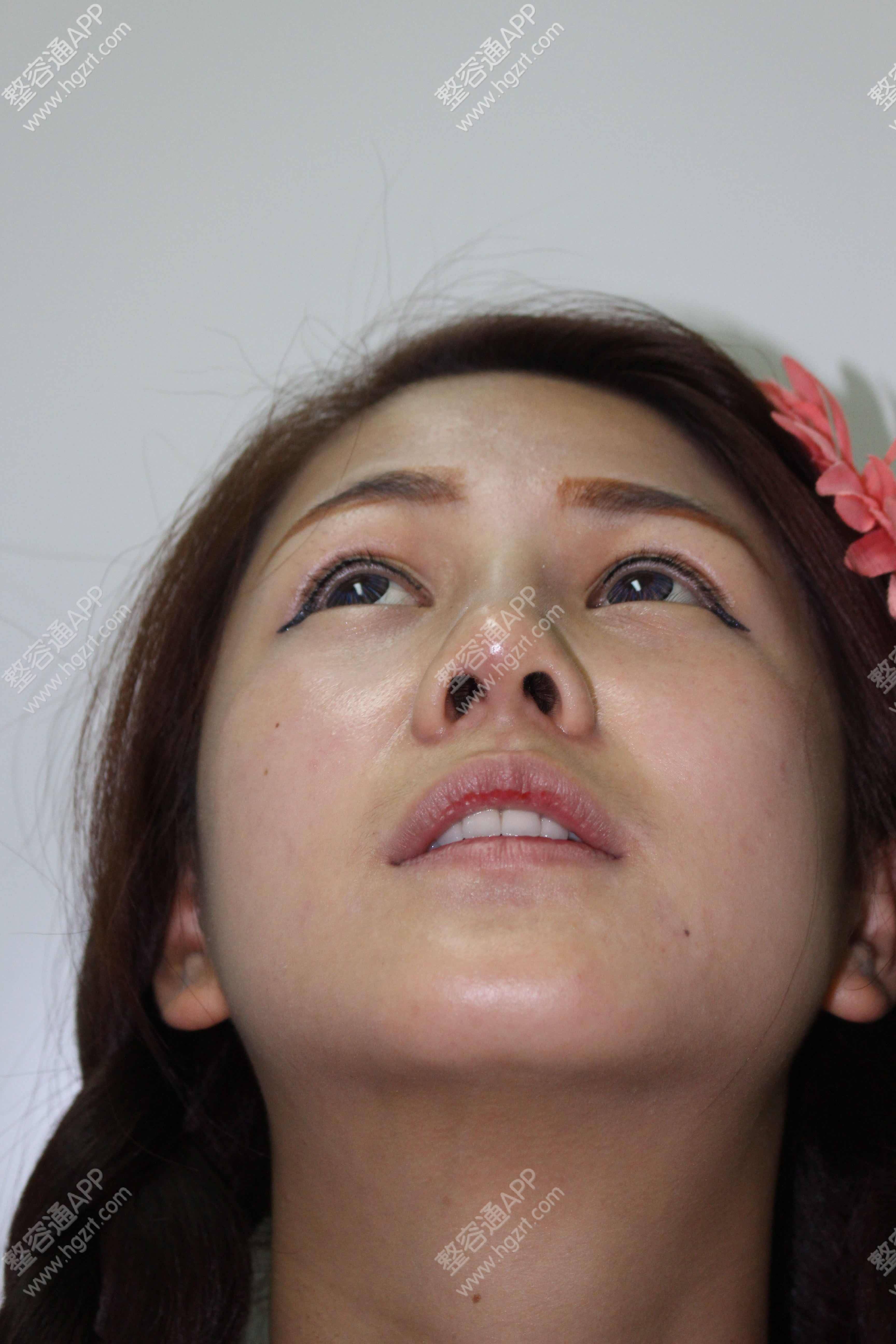 唇腭裂患者的第N次修复重建——鼻综合精细调整 - 知乎