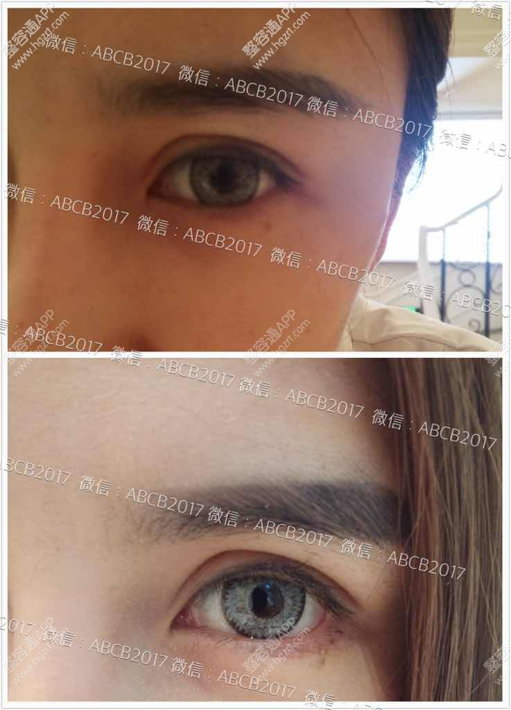 欧式双眼皮与下至手术