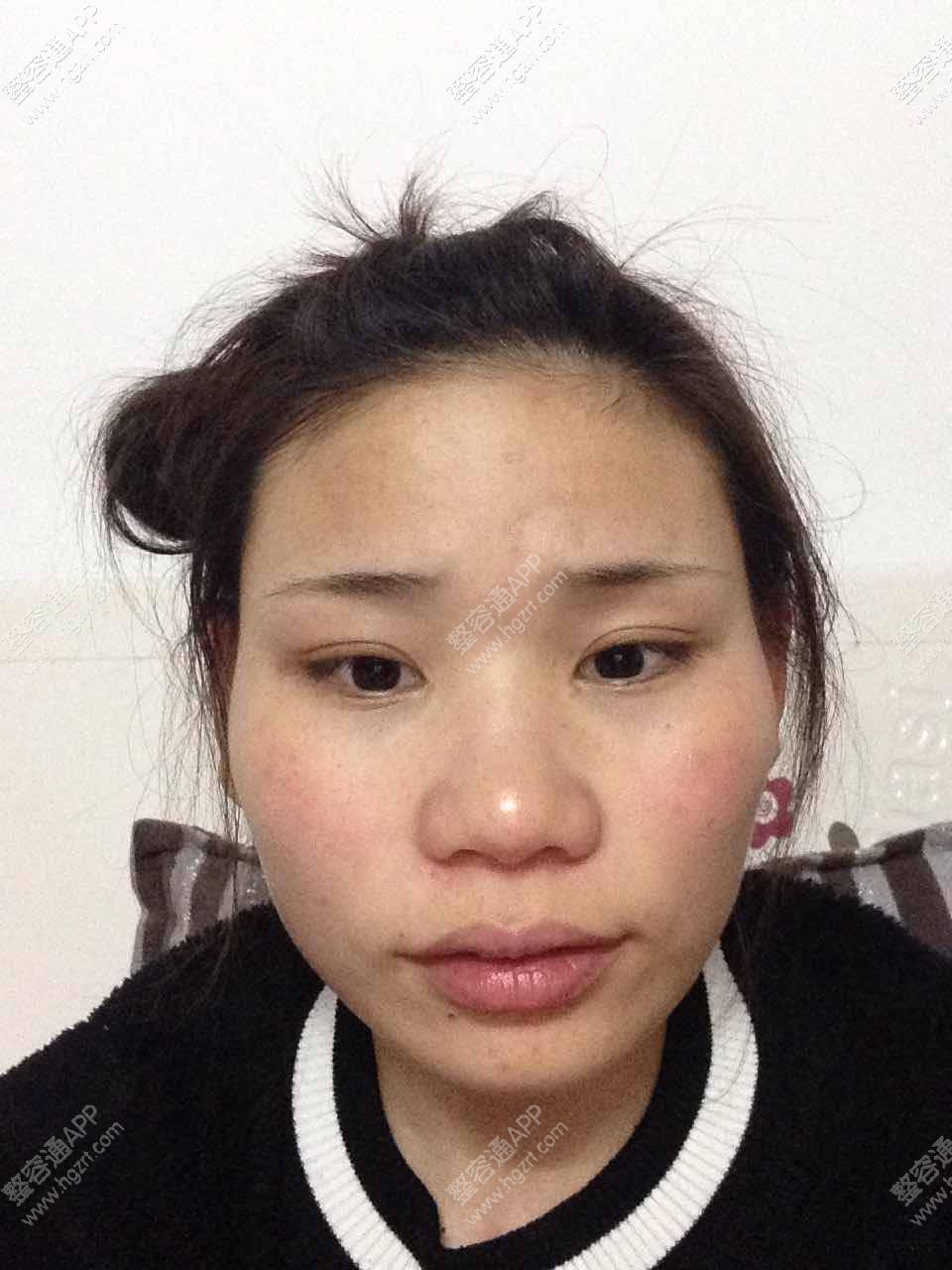 颧骨内推加下颌角截骨多少钱 下颌骨内推怎么做