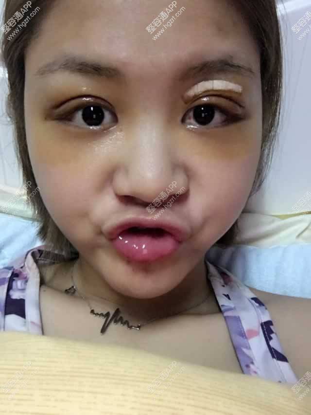 肿眼泡做完吸脂切开双眼皮的一周恢复效果案例,现在恢复的已很自然