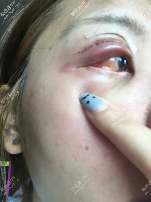 肿眼泡做完吸脂切开双眼皮的一周恢复效果案例,现在恢复的已很自然