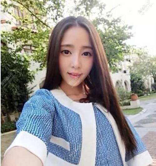 外伤导致脸部右侧颧骨处的软组织重建修复后
