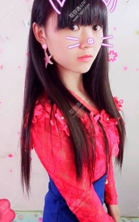 下颌角内推整形假想图