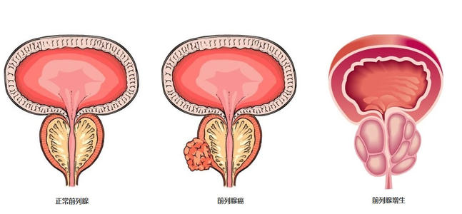 前列腺增生又常常被称作良性前列腺增生