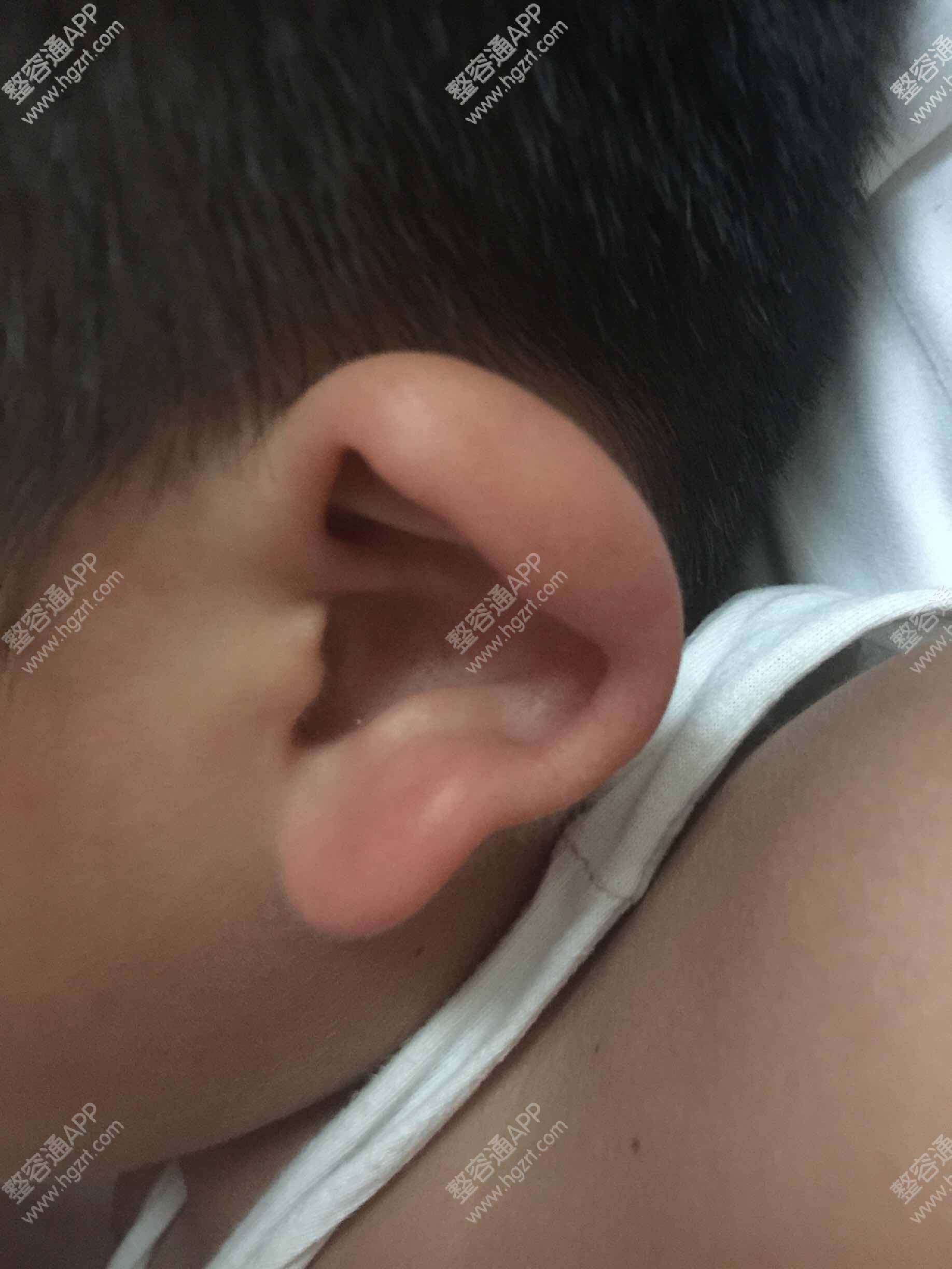 先天畸形如何投保 11岁男孩耳朵外观畸形能买保险吗